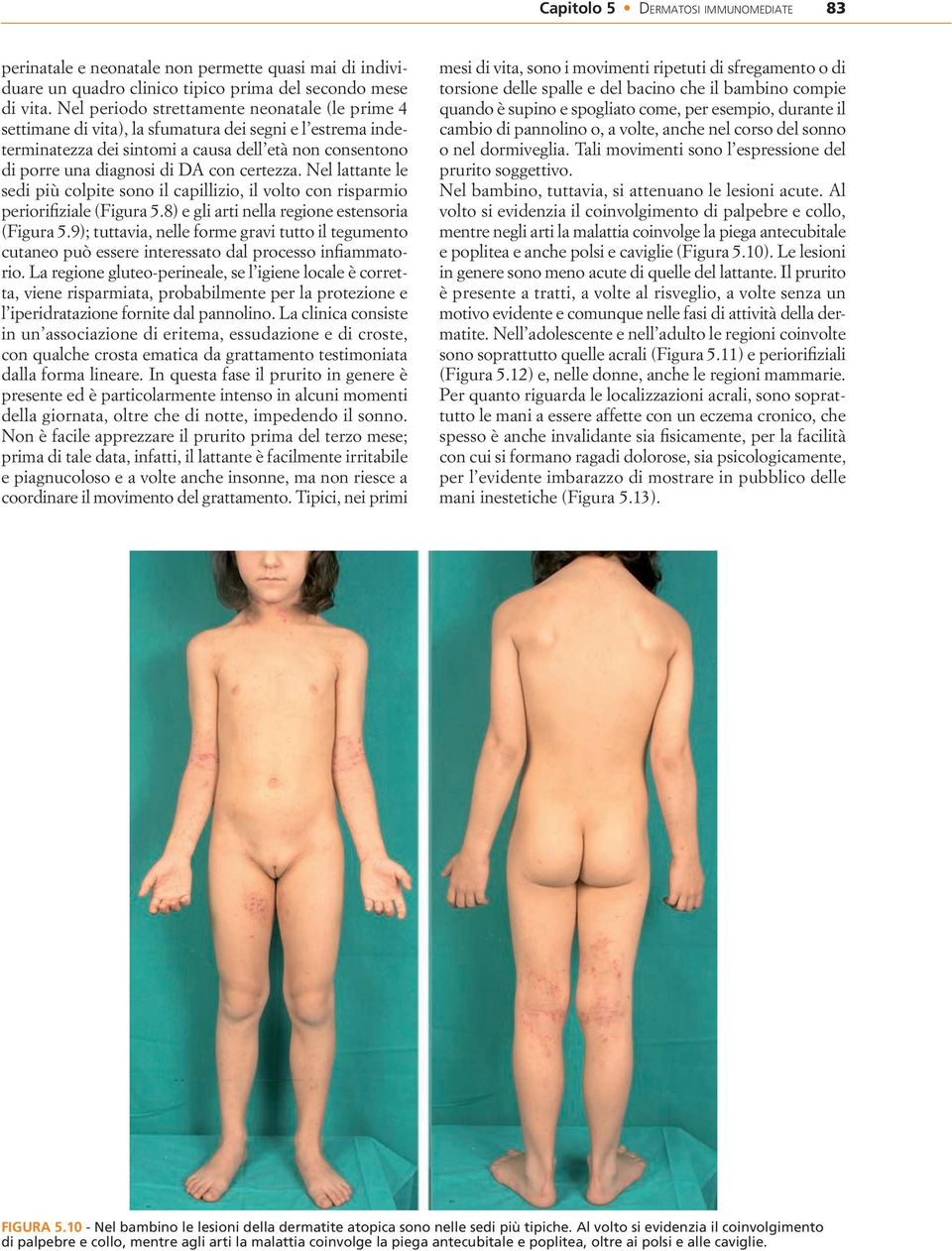 certezza. Nel lattante le sedi più colpite sono il capillizio, il volto con risparmio periorifiziale ( Figura 5.8 ) e gli arti nella regione estensoria ( Figura 5.