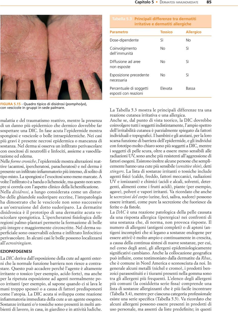 precedente necessaria Percentuale di soggetti esposti con reazioni No No No Elevata Sì Sì Sì Bassa FIGURA 5.15 - Quadro tipico di disidrosi ( pompholyx ), con vescicole in gruppi in sede palmare.