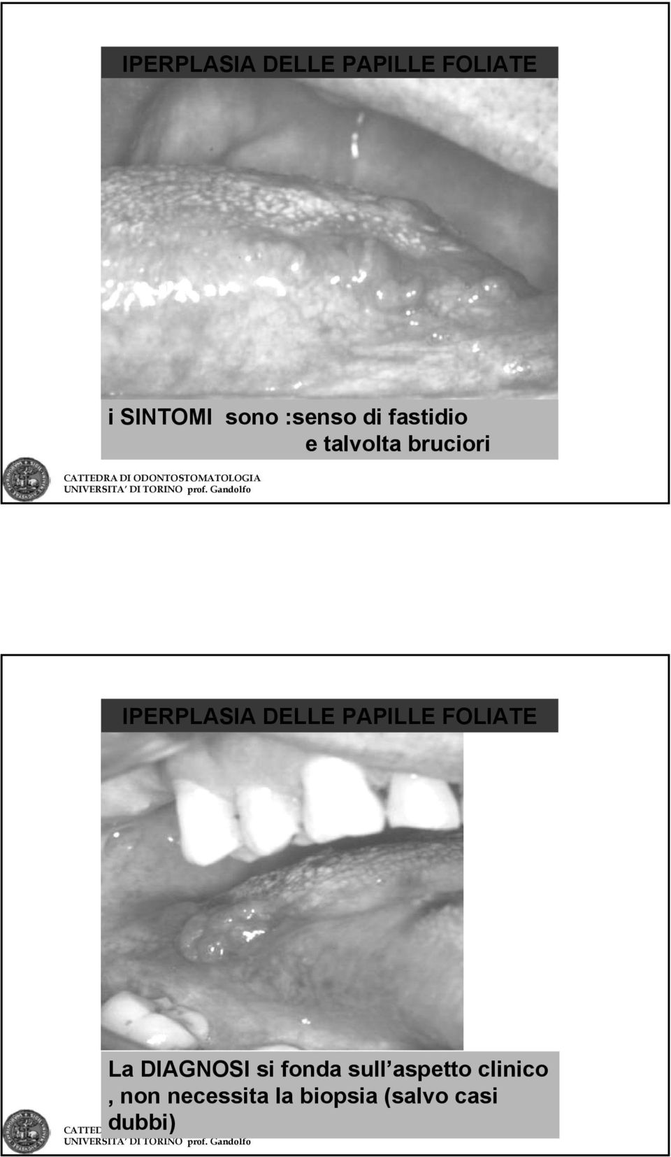 DELLE PAPILLE FOLIATE La DIAGNOSI si fonda sull