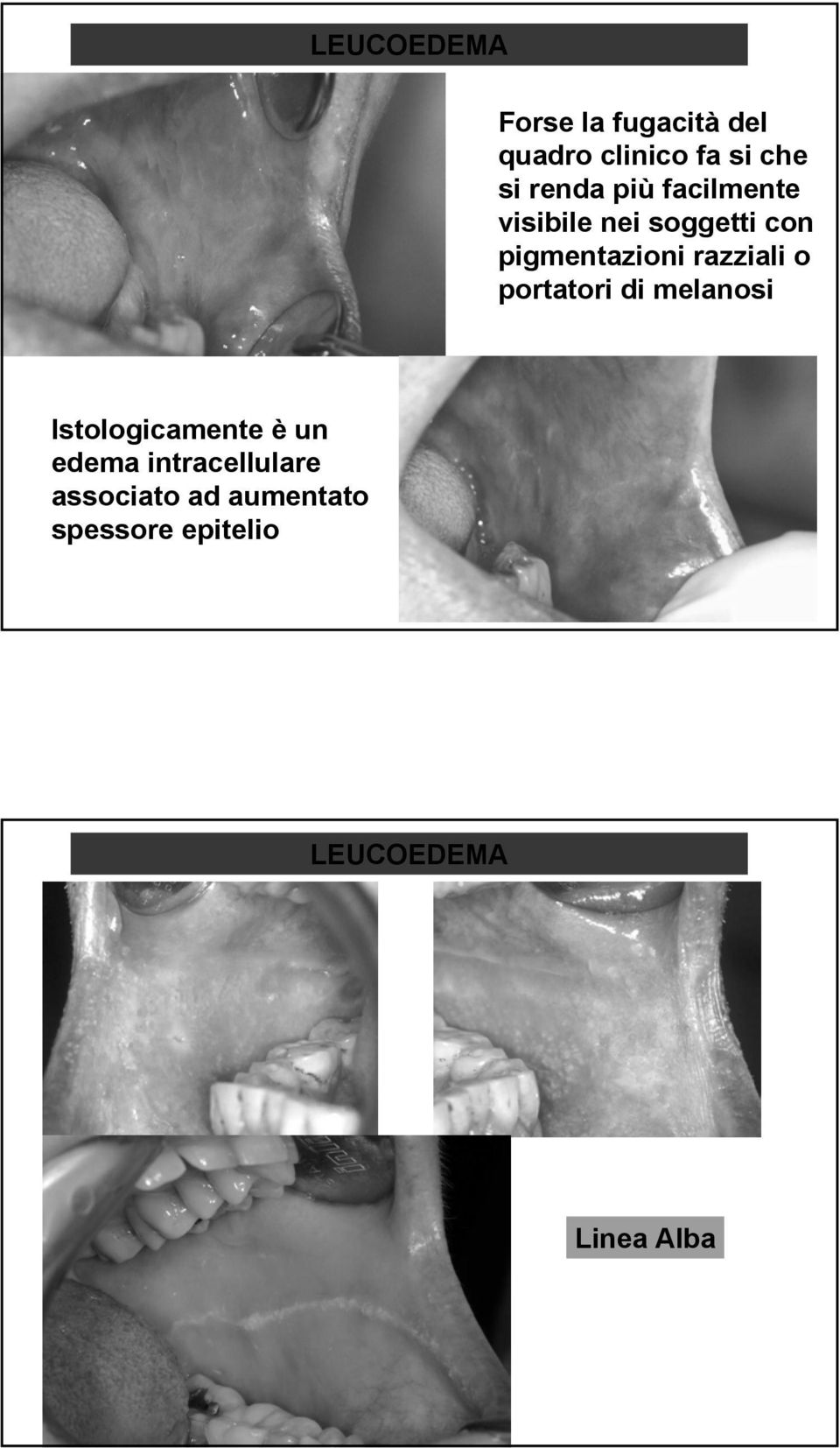 razziali o portatori di melanosi Istologicamente è un edema