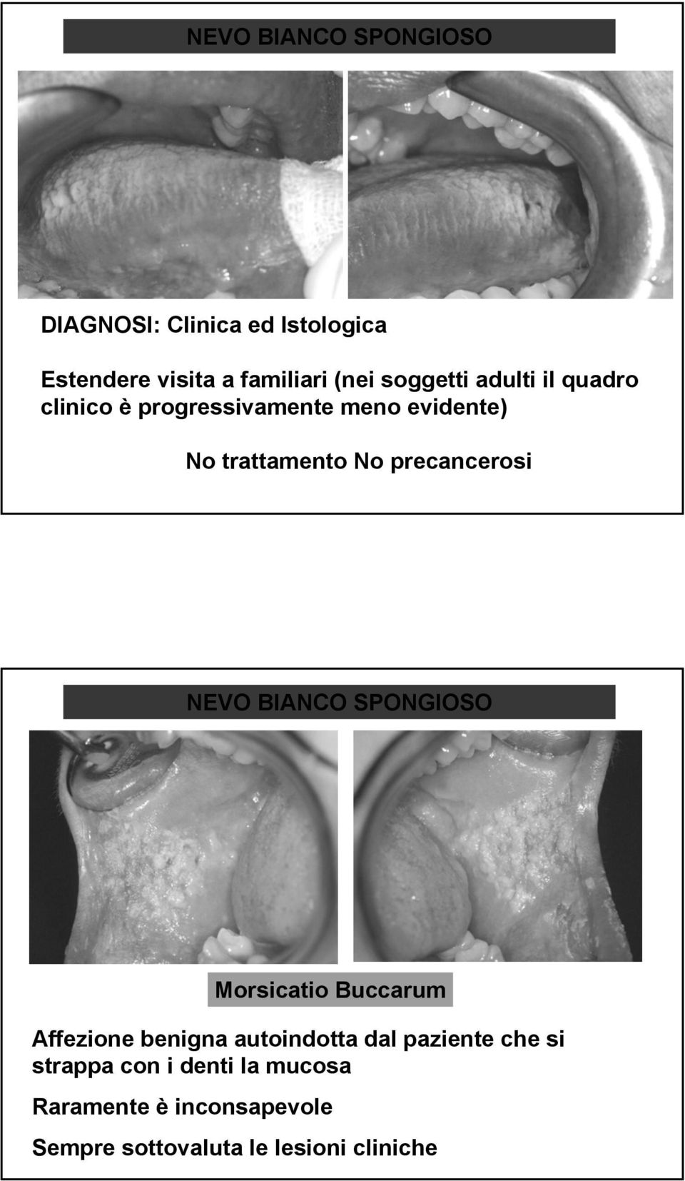 precancerosi NEVO BIANCO SPONGIOSO Morsicatio Buccarum Affezione benigna autoindotta dal