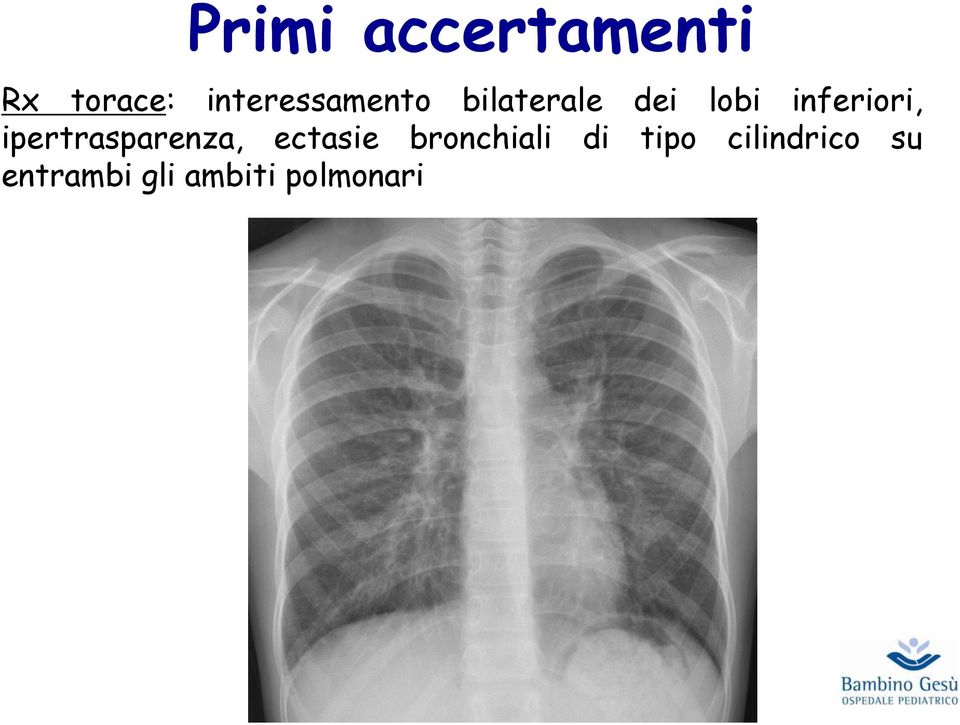 inferiori, ipertrasparenza, ectasie