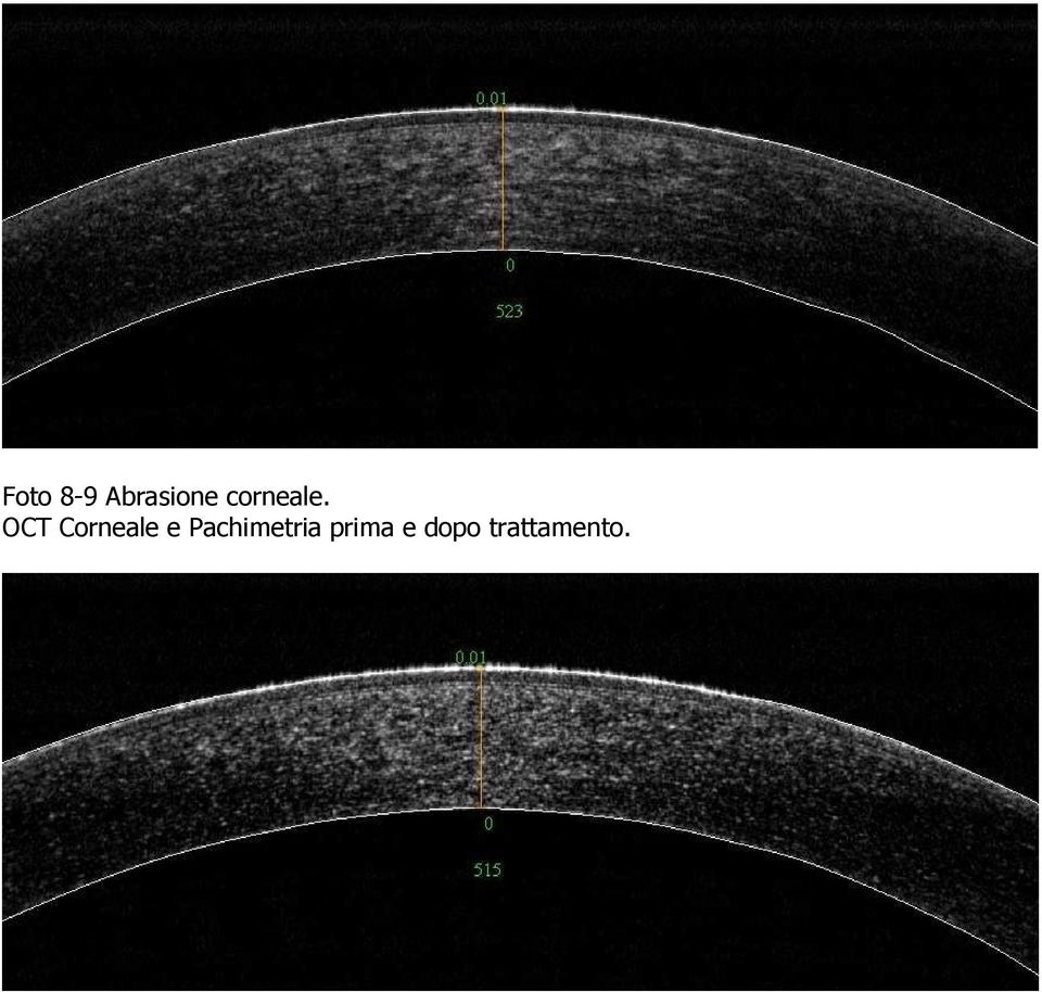 OCT Corneale e