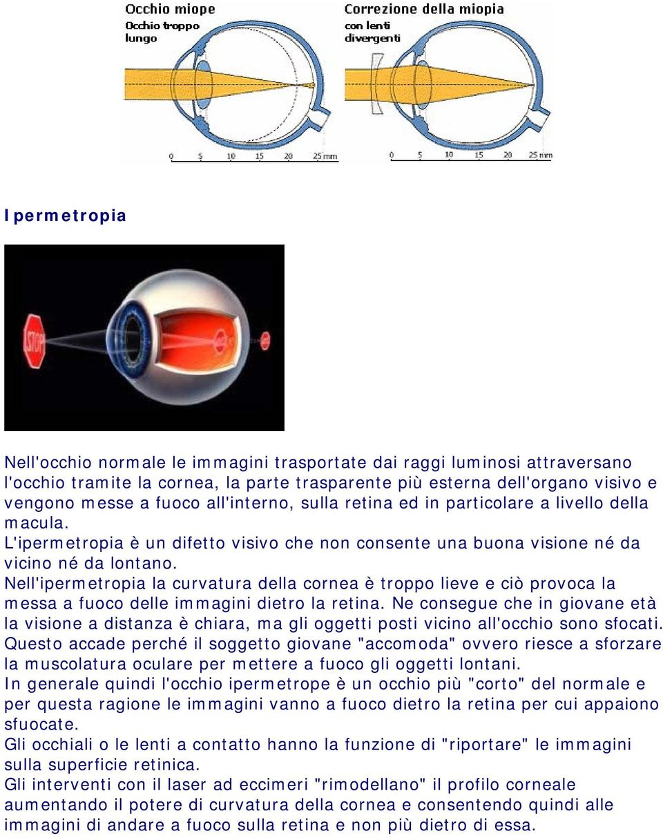 Nell'ipermetropia la curvatura della cornea è troppo lieve e ciò provoca la messa a fuoco delle immagini dietro la retina.