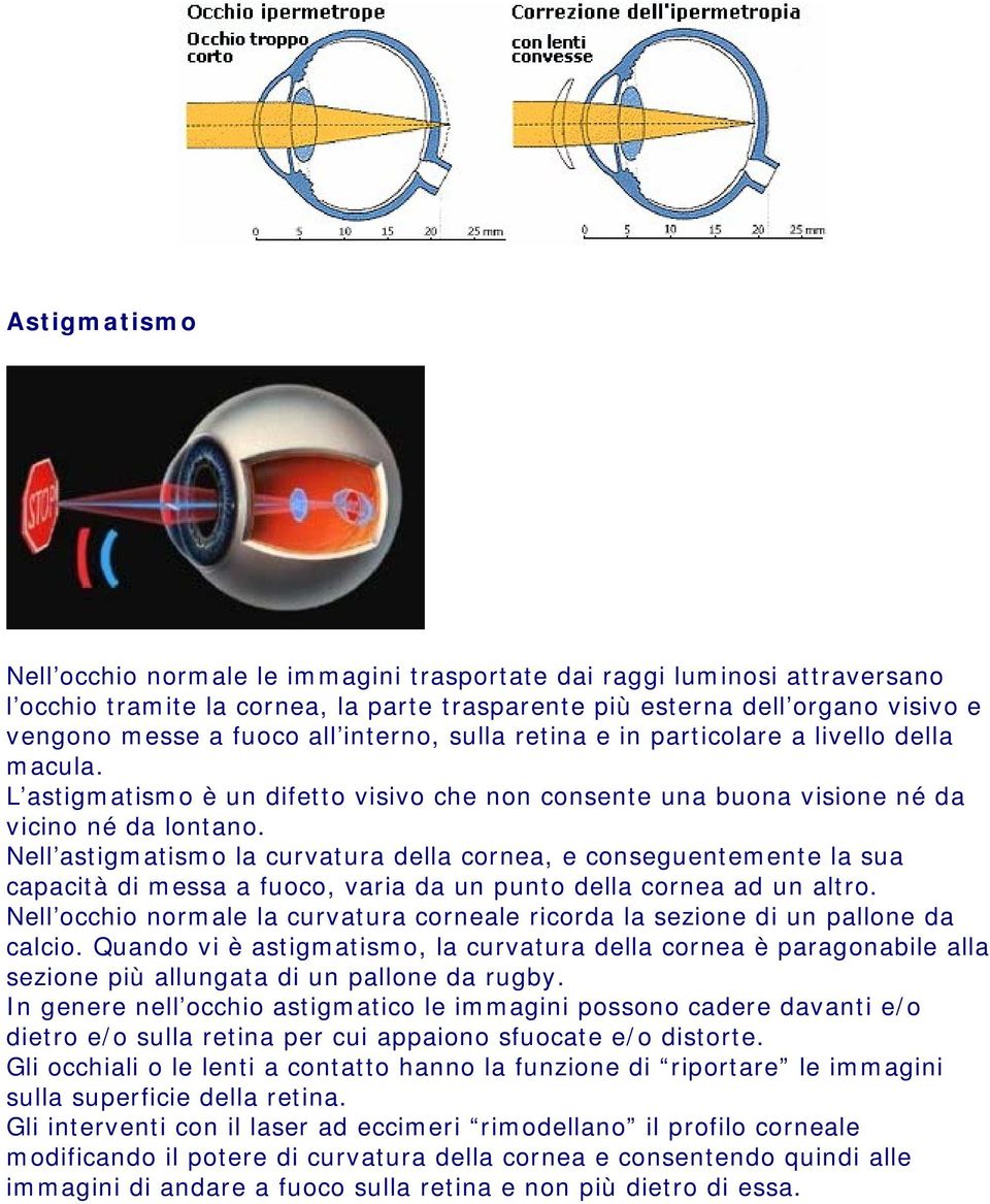 Nell astigmatismo la curvatura della cornea, e conseguentemente la sua capacità di messa a fuoco, varia da un punto della cornea ad un altro.