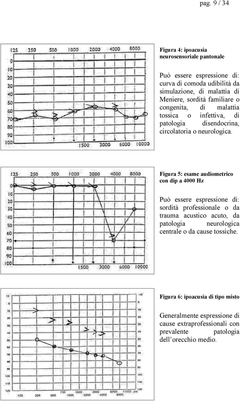 Figura 5: esame audiometrico con dip a 4000 Hz Può essere espressione di: sordità professionale o da trauma acustico acuto, da patologia