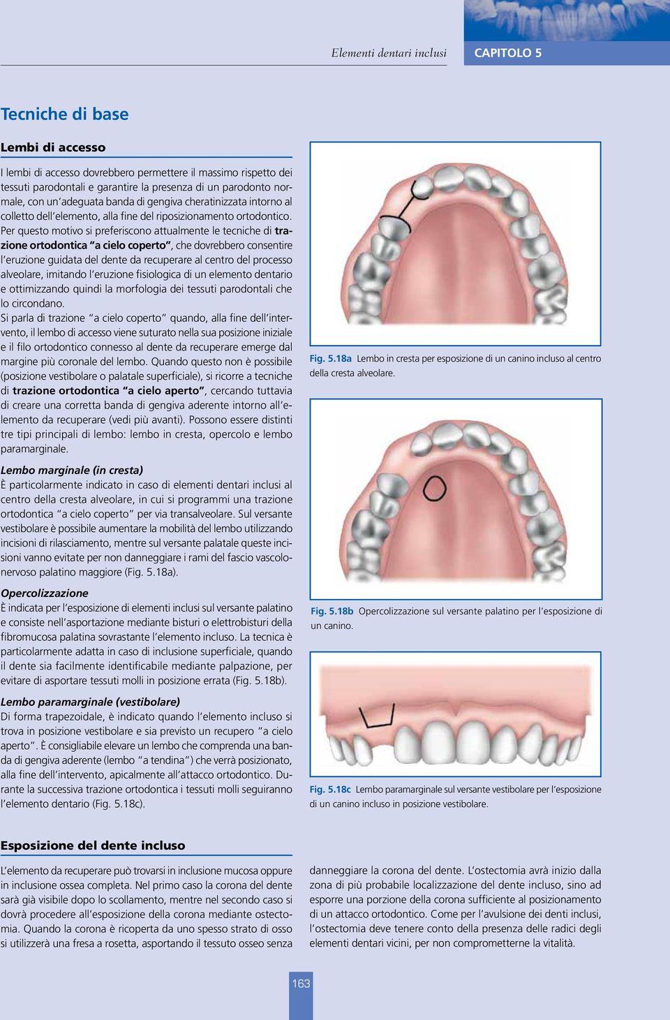 Per questo motivo si preferiscono attualmente le tecniche di trazione ortodontica a cielo coperto, che dovrebbero consentire l eruzione guidata del dente da recuperare al centro del processo