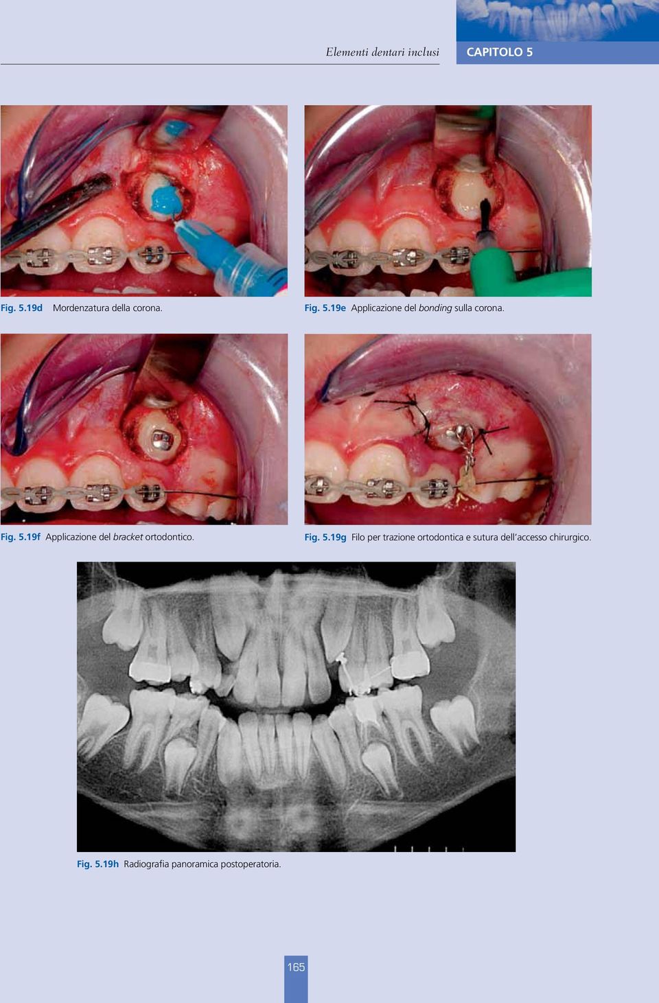 Fig. 5.19g Filo per trazione ortodontica e sutura dell accesso chirurgico.