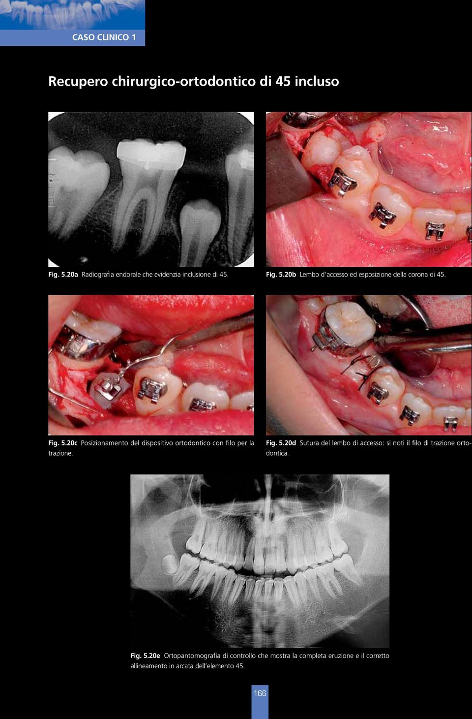 Fig. 5.20c Posizionamento del dispositivo ortodontico con filo per la trazione. Fig. 5.20d Sutura del lembo di accesso: si noti il filo di trazione ortodontica.