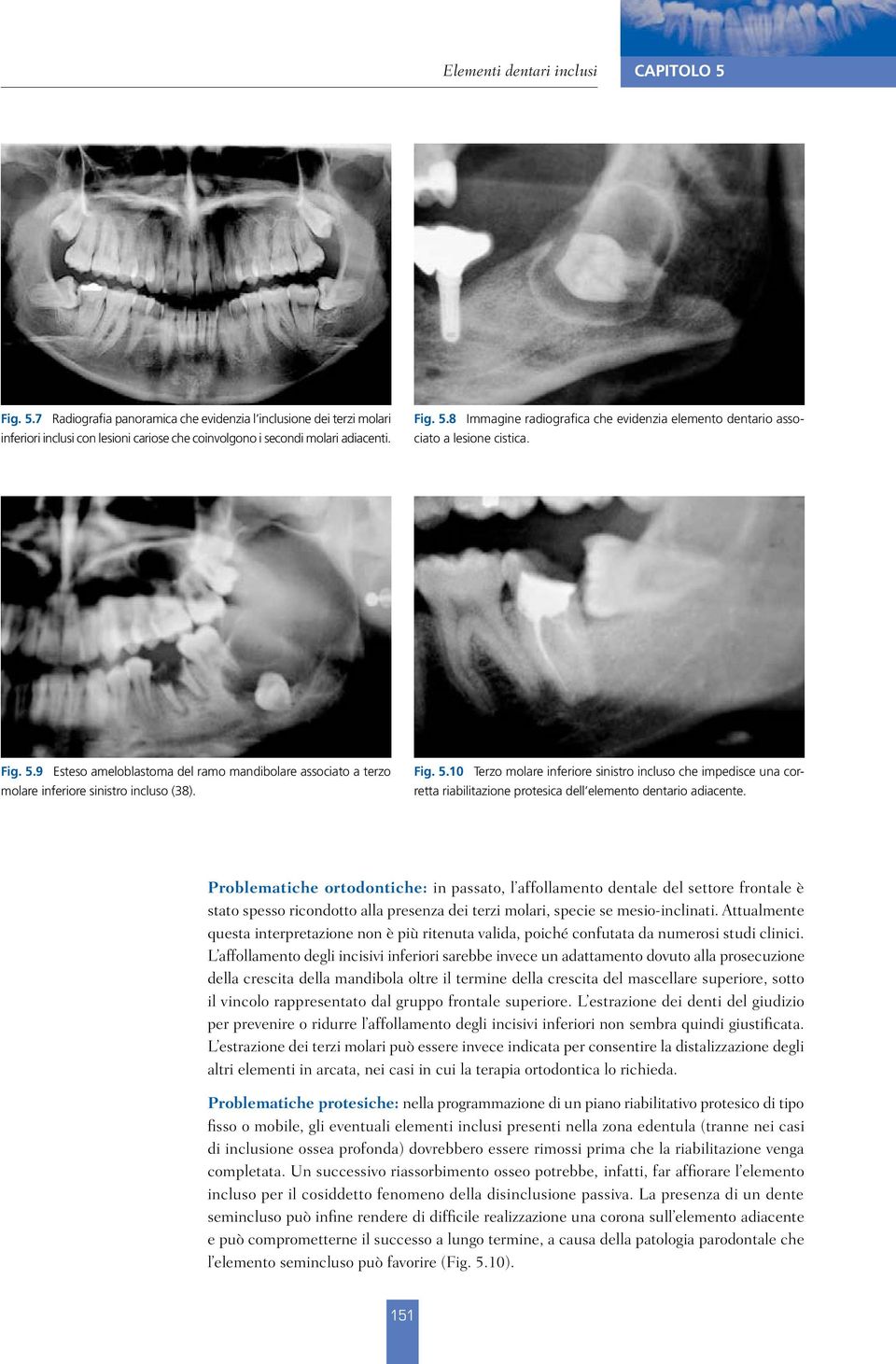 Problematiche ortodontiche: in passato, l affollamento dentale del settore frontale è stato spesso ricondotto alla presenza dei terzi molari, specie se mesio-inclinati.