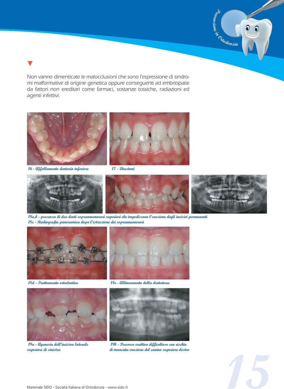 16 - Affollamento dentario inferiore 17 - Diastemi 18a,b - presenza di due denti soprannumerari superiori che impediscono l eruzione degli incisivi permanenti 18c - Radiografia