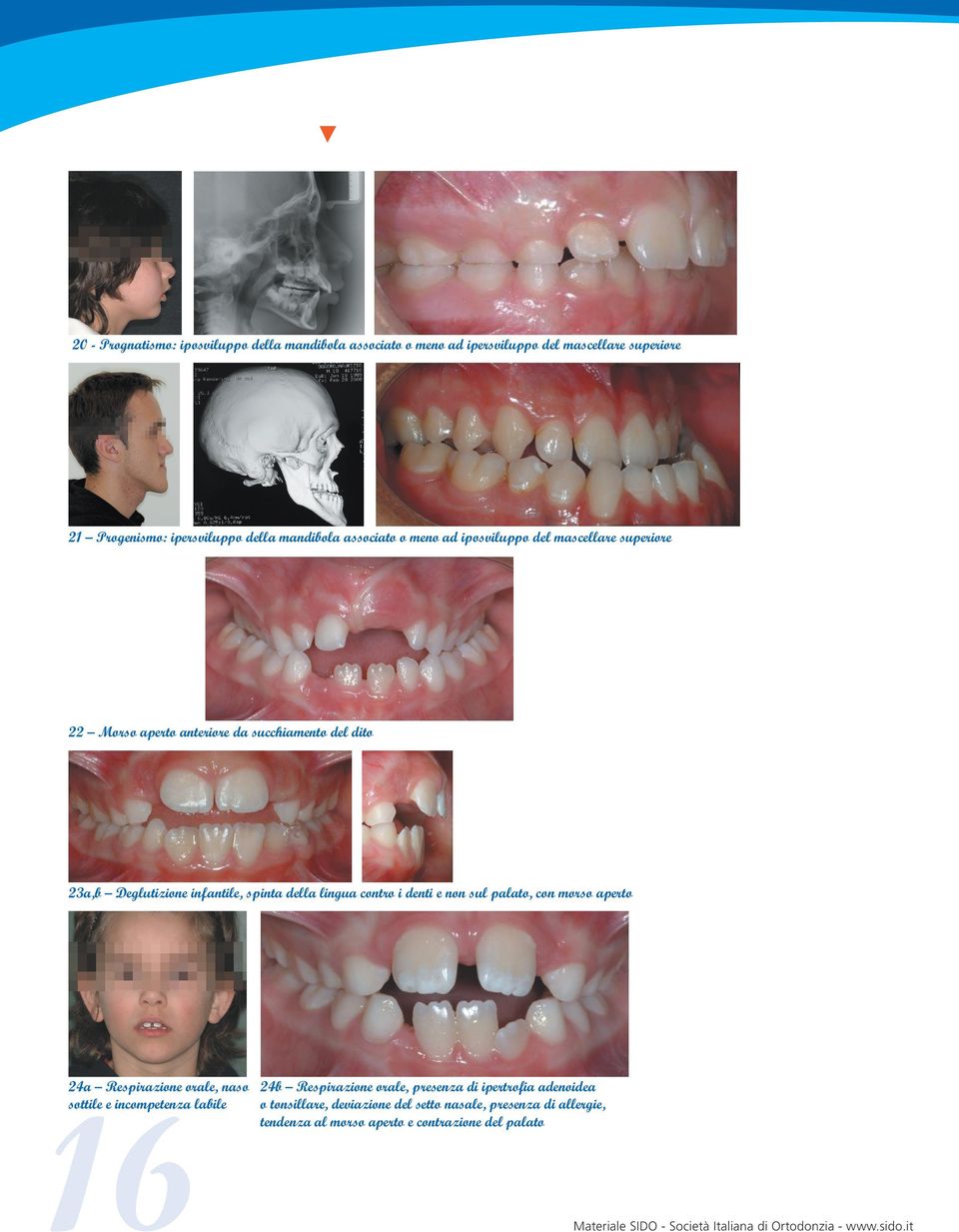 della lingua contro i denti e non sul palato, con morso aperto 24a Respirazione orale, naso 16 sottile e incompetenza labile 24b Respirazione