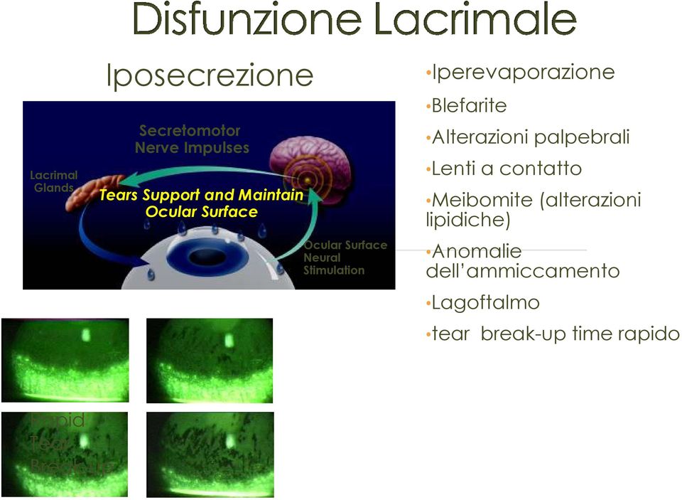 Blefarite Alterazioni palpebrali Lenti a contatto Meibomite (alterazioni