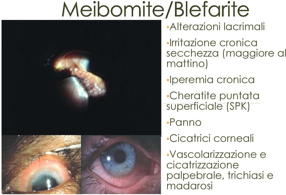 puntata superficiale (SPK) Panno Cicatrici corneali