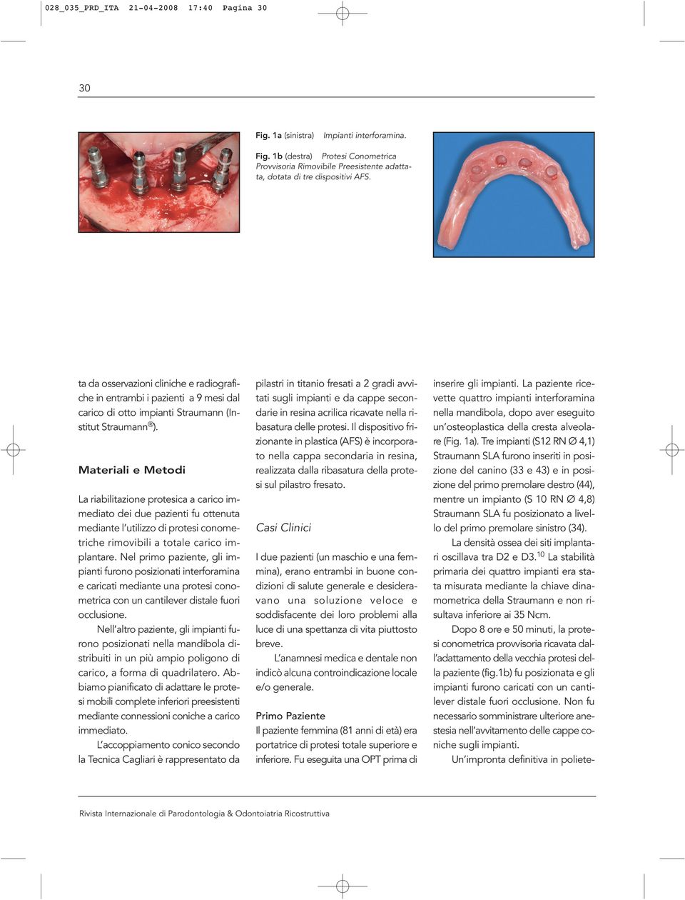 Materiali e Metodi La riabilitazione protesica a carico immediato dei due pazienti fu ottenuta mediante l utilizzo di protesi conometriche rimovibili a totale carico implantare.