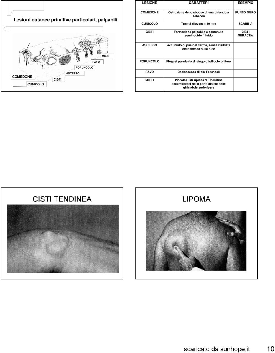 visibilità dello stesso sulla cute MILIO FAVO FORUNCOLO Flogosi purulenta di singolo follicolo pilifero COMEDONE CUNICOLO CISTI ASCESSO FORUNCOLO FAVO