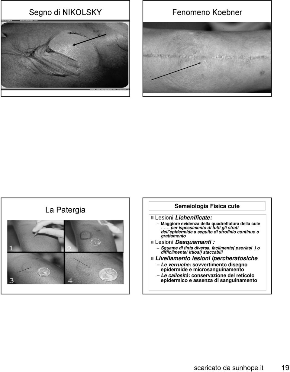 Squame di tinta diversa, facilmente( psoriasi ) o difficilmente( ittiosi) staccabili Livellamento lesioni ipercheratosiche Le