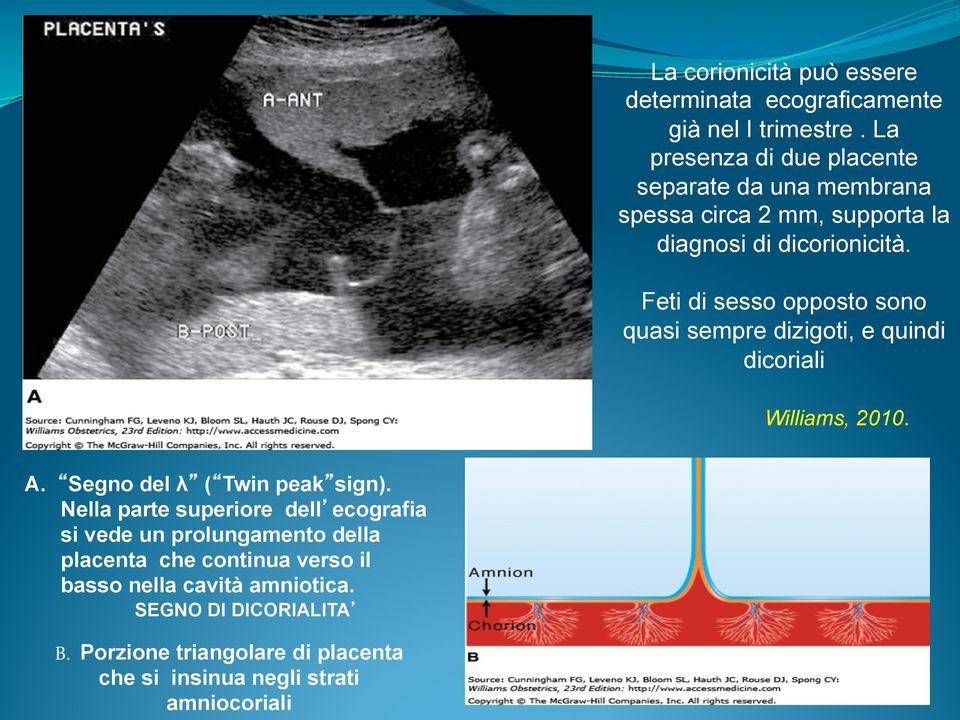 Feti di sesso opposto sono quasi sempre dizigoti, e quindi dicoriali Williams, 2010. A. Segno del λ ( Twin peak sign).