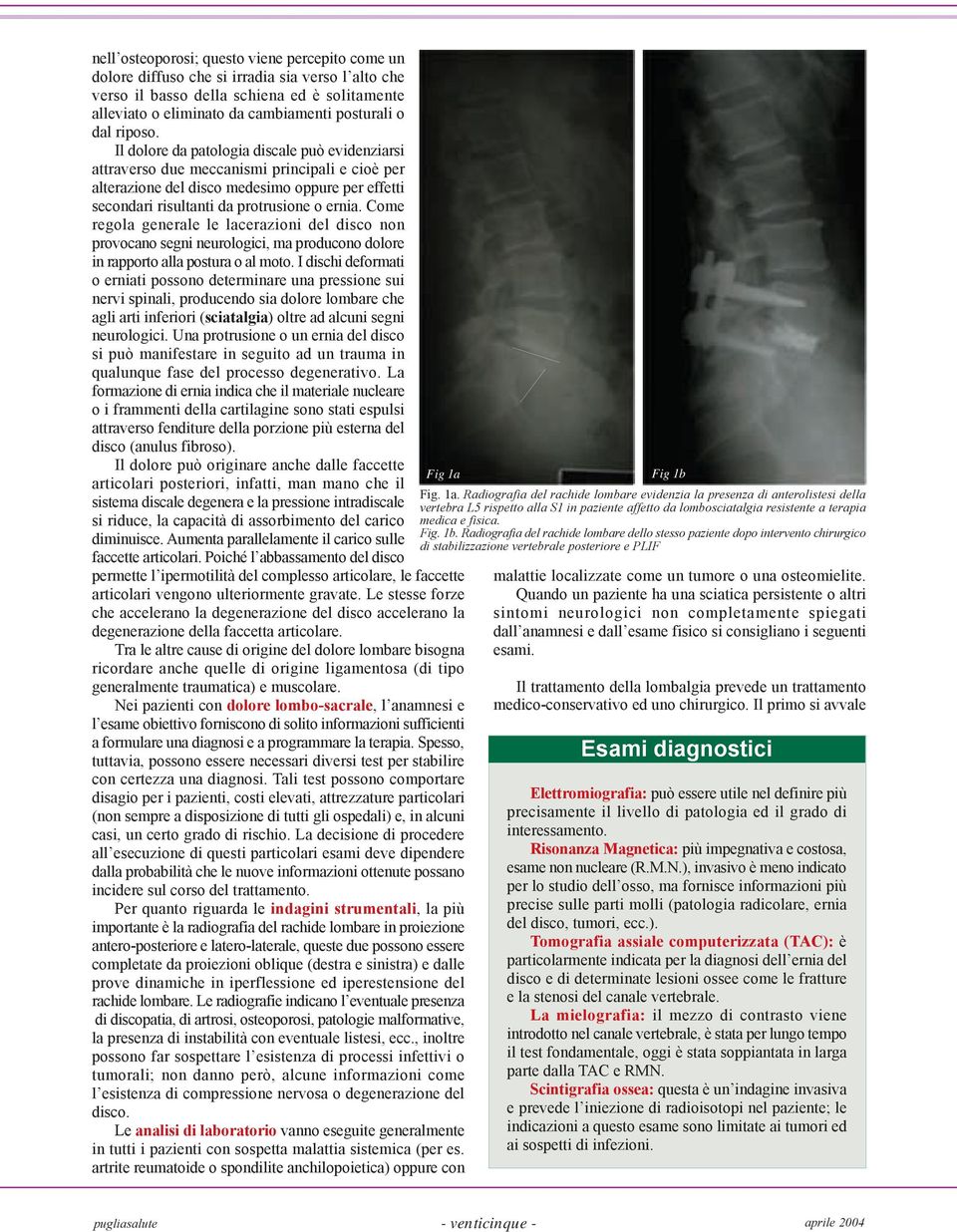 Come regola generale le lacerazioni del disco non provocano segni neurologici, ma producono dolore in rapporto alla postura o al moto.