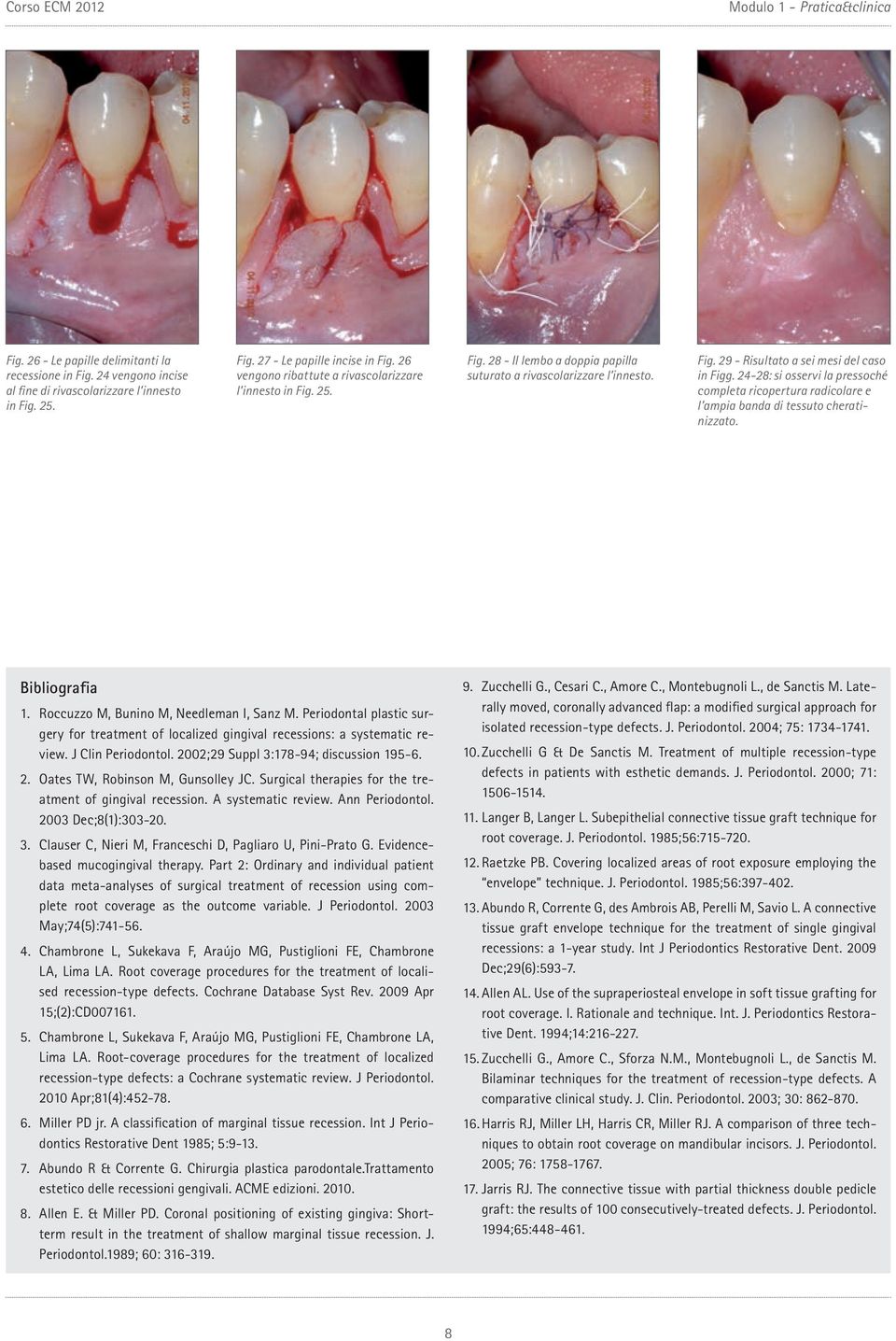 24-28: si osservi la pressoché completa ricopertura radicolare e l ampia banda di tessuto cheratinizzato. Bibliografia 1. Roccuzzo M, Bunino M, Needleman I, Sanz M.