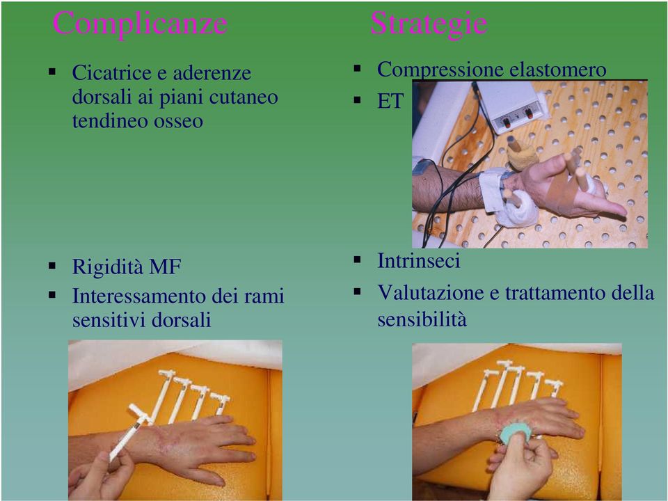 ET Rigidità MF Interessamento dei rami sensitivi