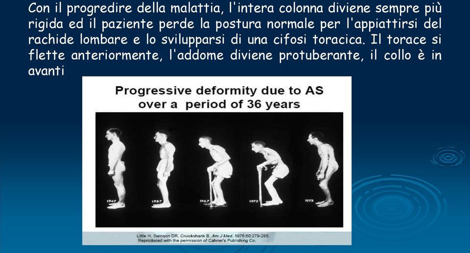 rachide lombare e lo svilupparsi di una cifosi toracica.