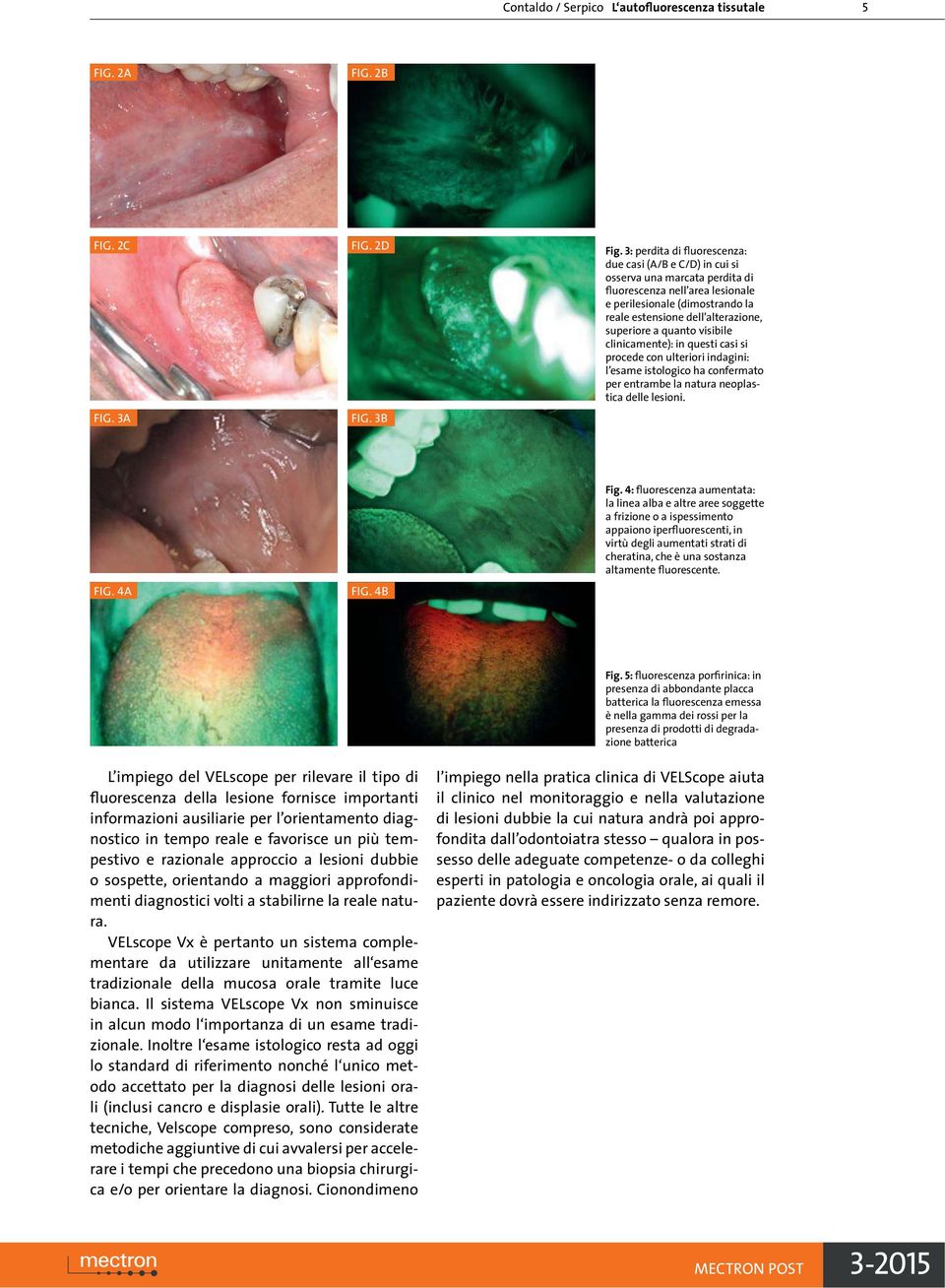 a quanto visibile clinicamente): in questi casi si procede con ulteriori indagini: l esame istologico ha confermato per entrambe la natura neoplastica delle lesioni. FIG. 4A FIG. 4B Fig.