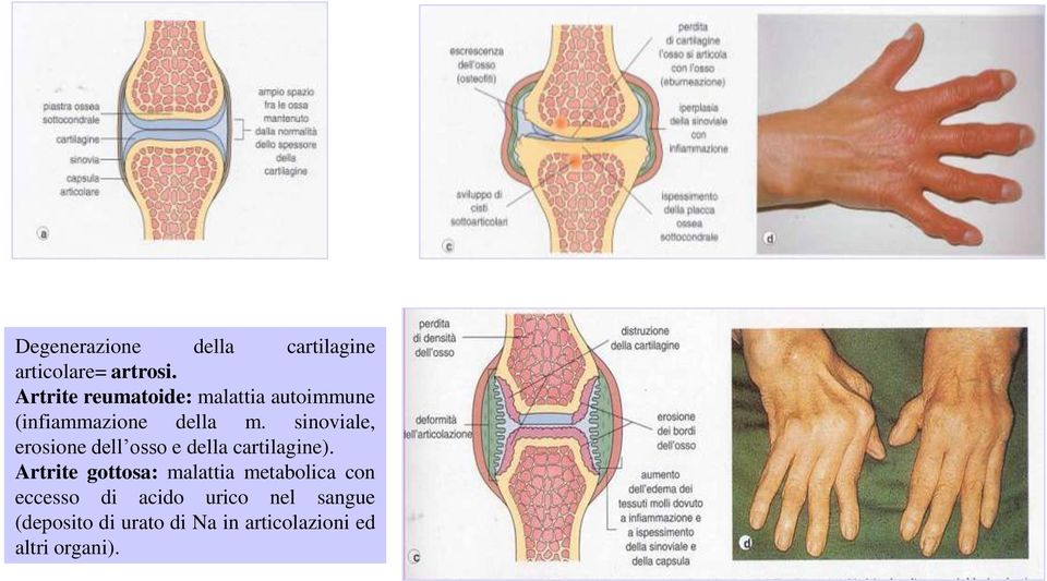 sinoviale, erosione dell osso e della cartilagine).