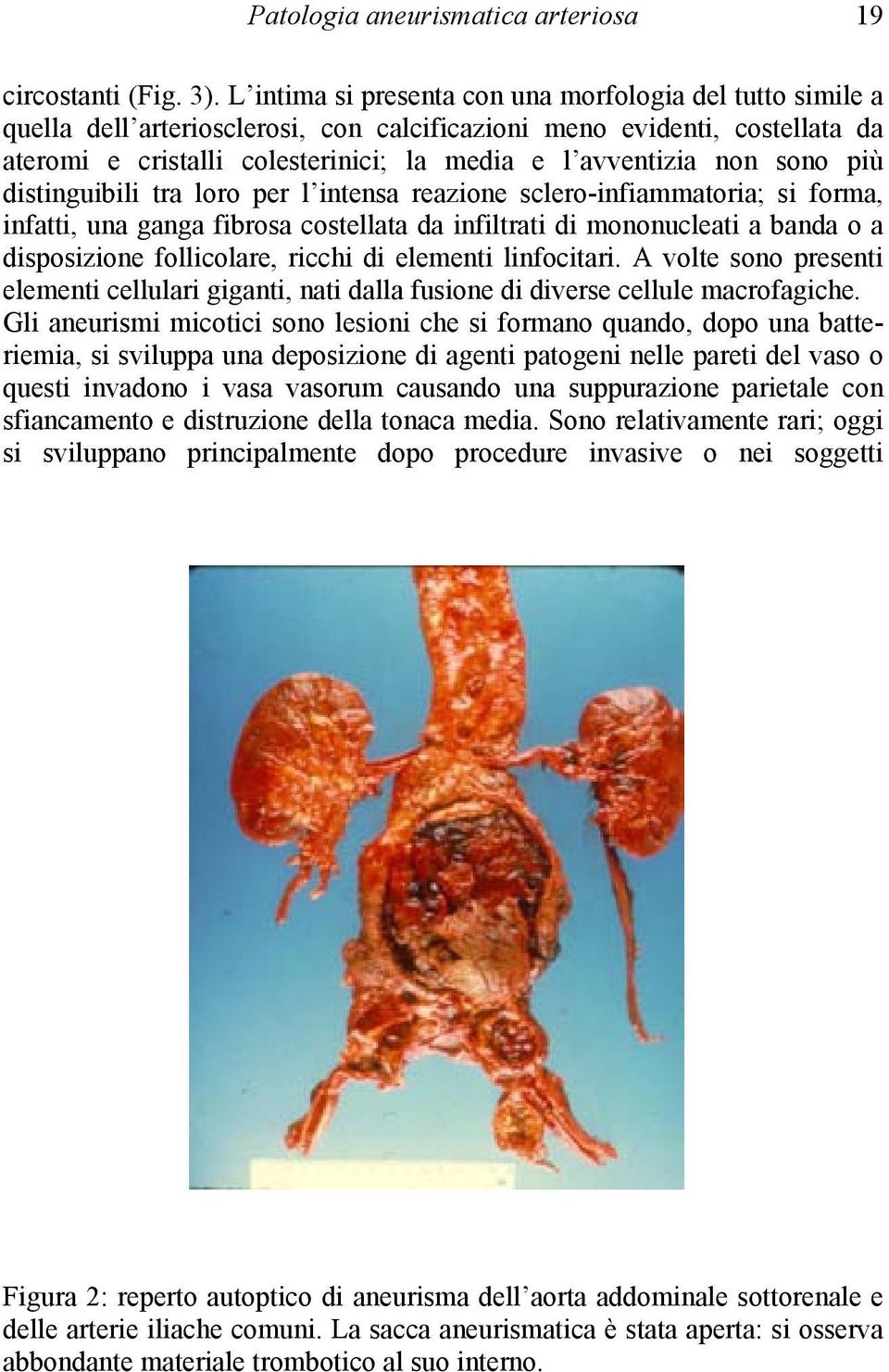 sono più distinguibili tra loro per l intensa reazione sclero-infiammatoria; si forma, infatti, una ganga fibrosa costellata da infiltrati di mononucleati a banda o a disposizione follicolare, ricchi