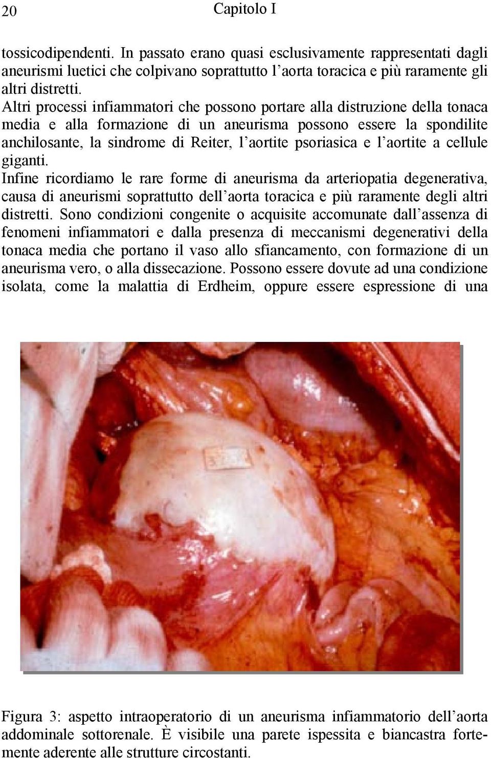 psoriasica e l aortite a cellule giganti.