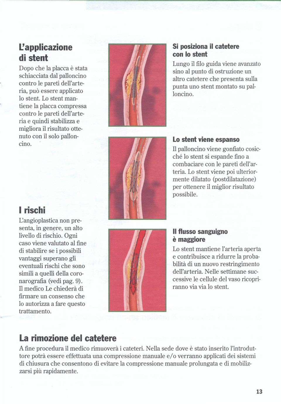 I rischi L'angioplastica non presenta, in genere, un alto livello di rischio.