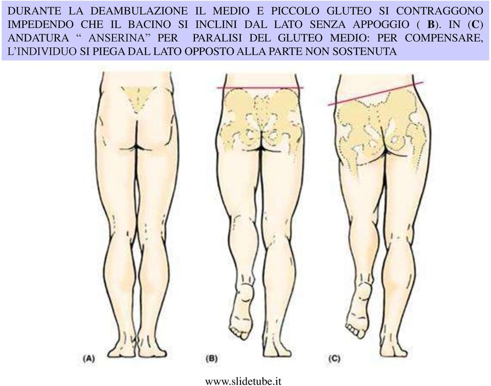 IN (C) ANDATURA ANSERINA PER PARALISI DEL GLUTEO MEDIO: PER