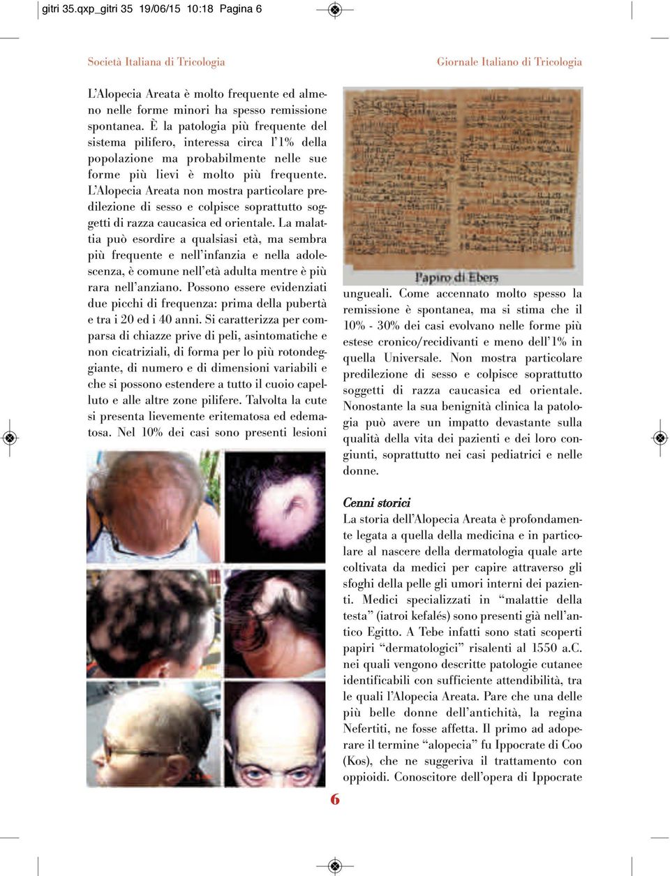 L Alopecia Areata non mostra particolare predilezione di sesso e colpisce soprattutto soggetti di razza caucasica ed orientale.