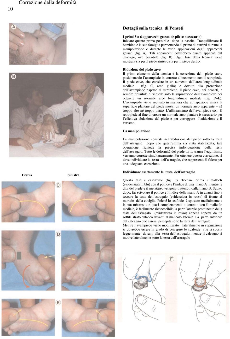 Tali apparecchi dovrebbero essere applicati dal chirurgo, ove possibile (fig. B). Ogni fase della tecnica viene mostrata sia per il piede sinistro sia per il piede destro.