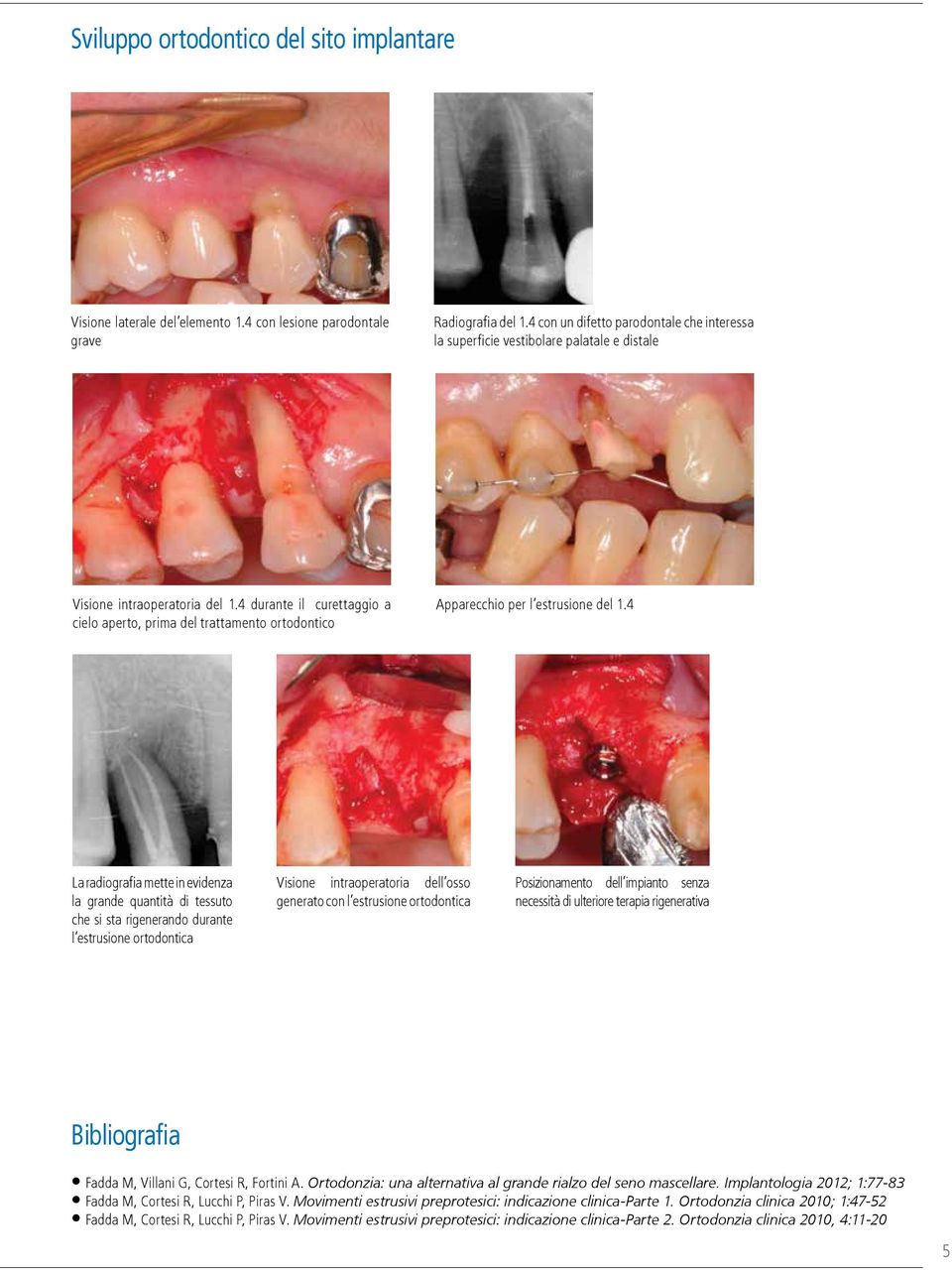 4 durante il curettaggio a cielo aperto, prima del trattamento ortodontico Apparecchio per l estrusione del 1.