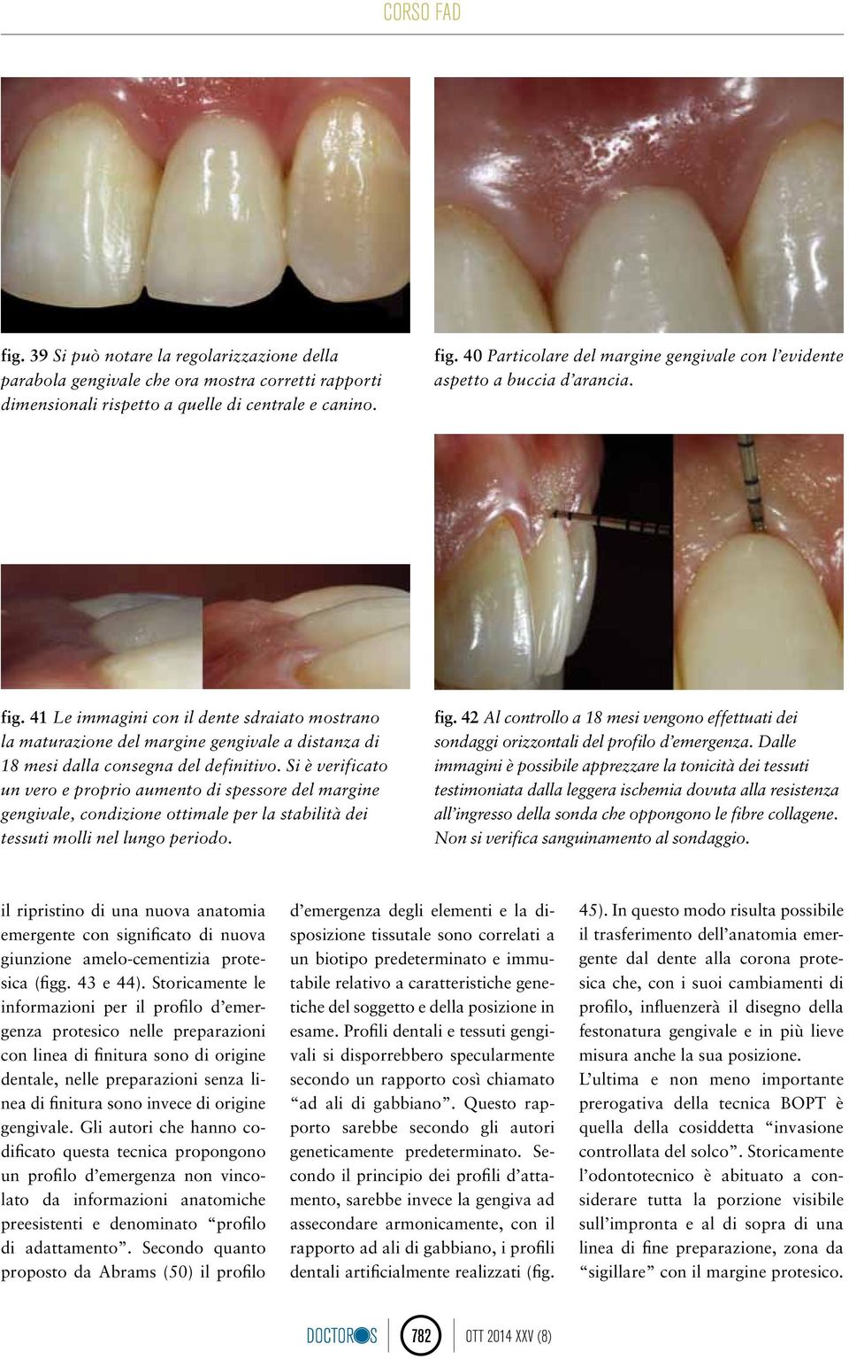 41 Le immagini con il dente sdraiato mostrano la maturazione del margine gengivale a distanza di 18 mesi dalla consegna del definitivo.