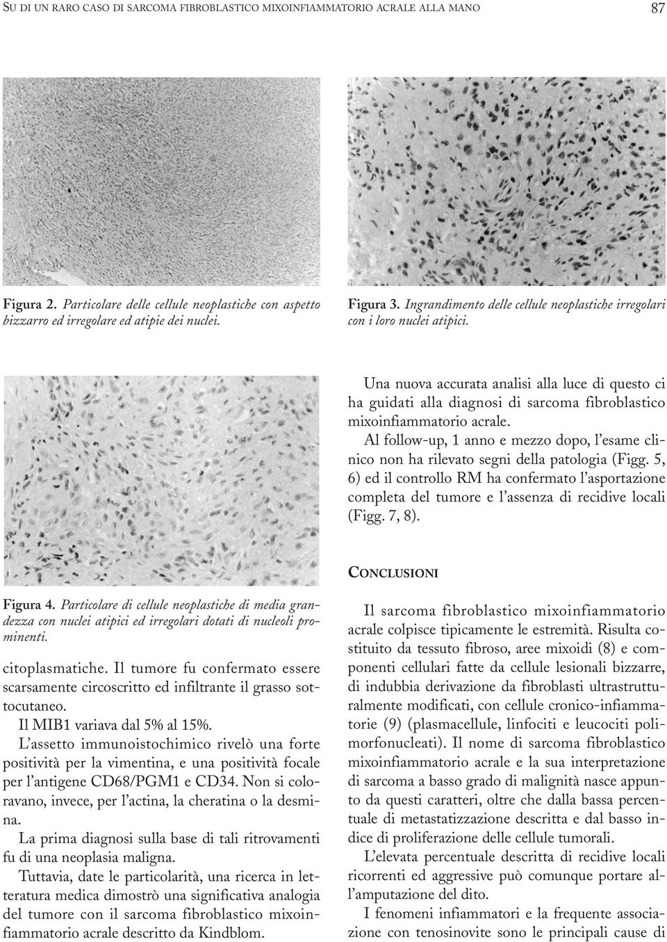 Una nuova accurata analisi alla luce di questo ci ha guidati alla diagnosi di sarcoma fibroblastico mixoinfiammatorio acrale.