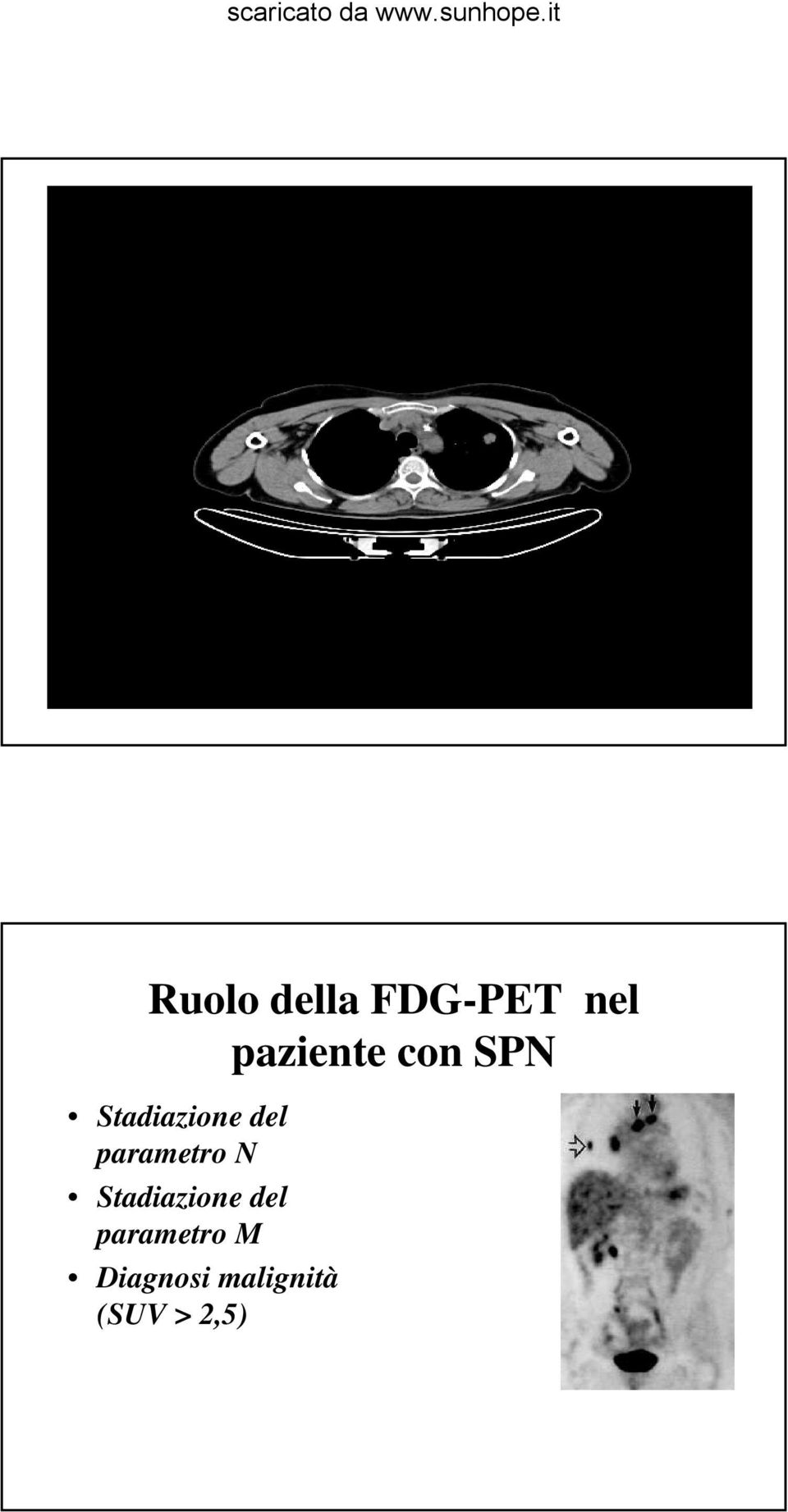 Stadiazione del parametro N Stadiazione