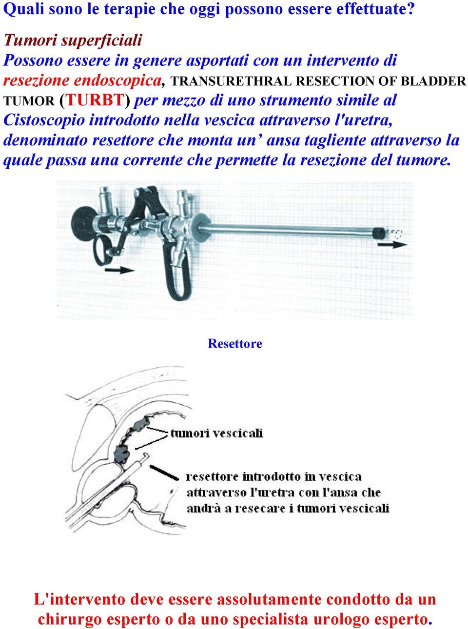 TUMOR (TURBT) per mezzo di uno strumento simile al Cistoscopio introdotto nella vescica attraverso l'uretra, denominato resettore che