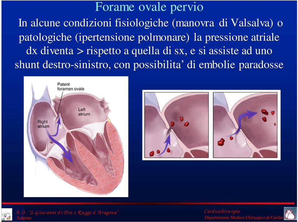 pressione atriale dx diventa > rispetto a quella di sx, e si