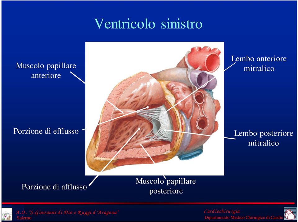 Porzione di efflusso Lembo posteriore