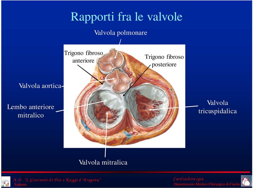 posteriore Valvola aortica Lembo anteriore