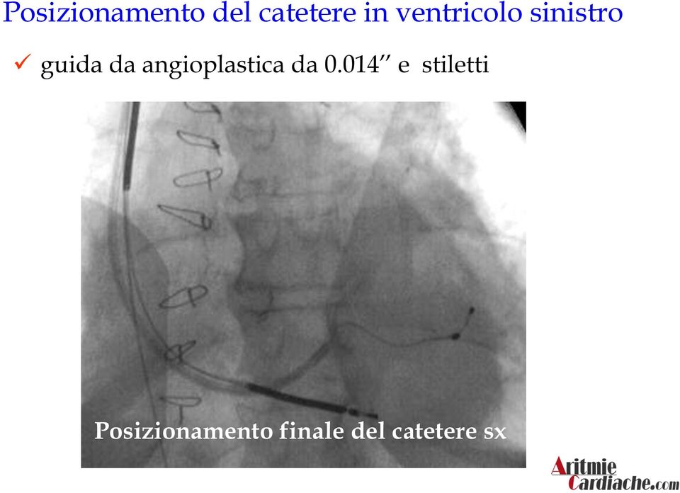 angioplastica da 0.