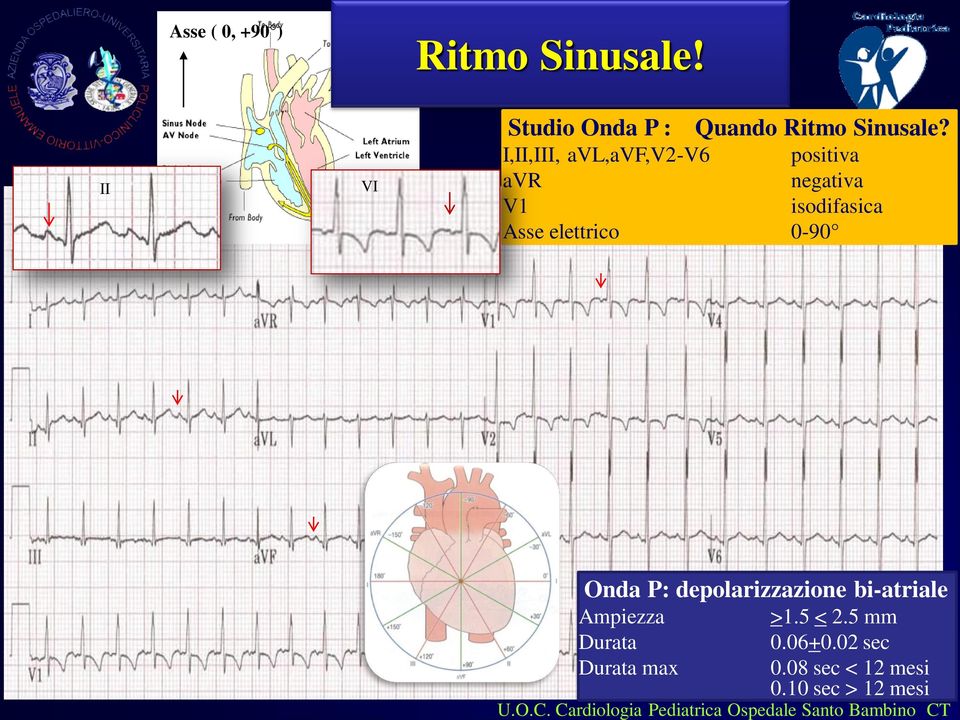 P: depolarizzazione bi-atriale Ampiezza >1.5 < 2.5 mm Durata 0.06+0.