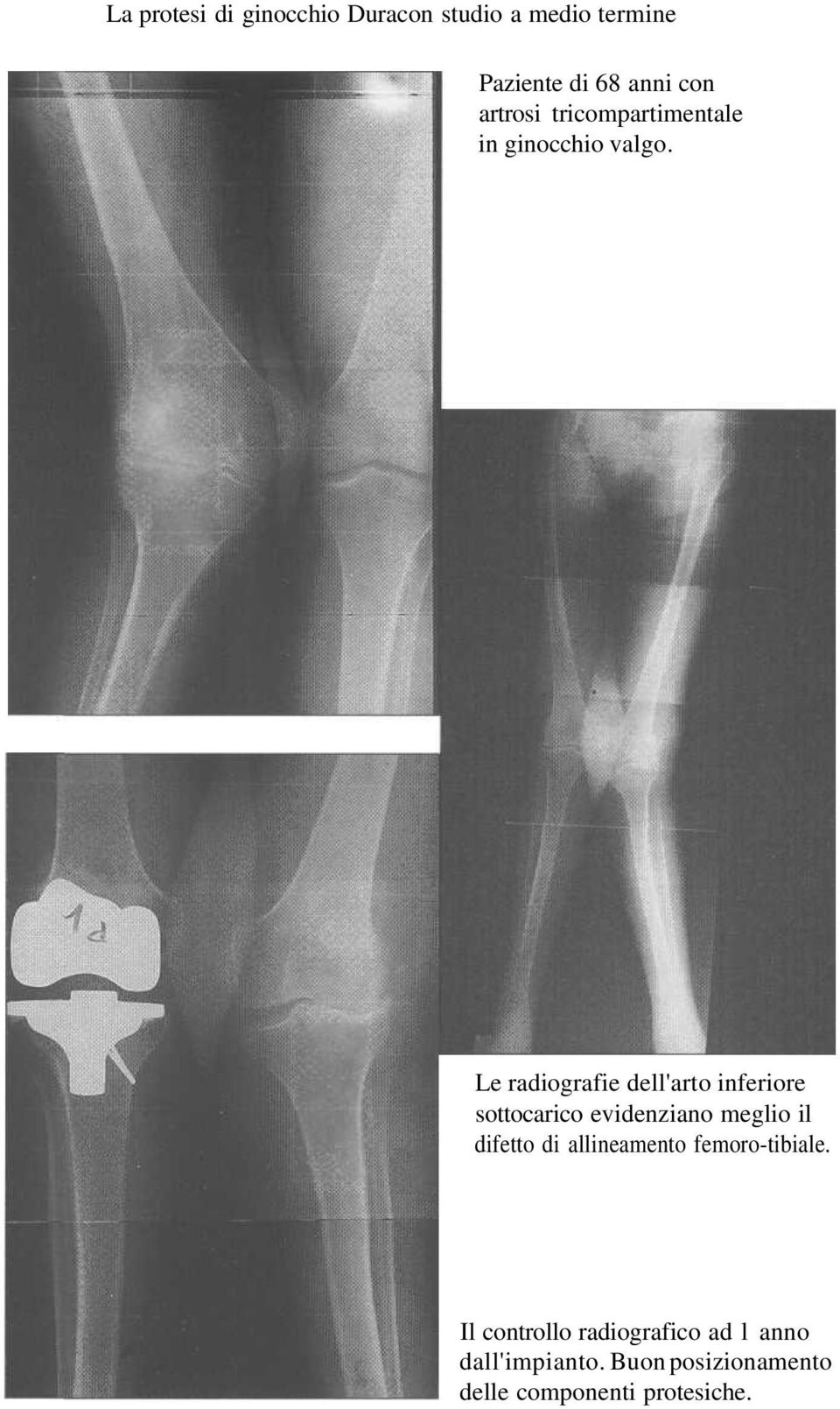 Le radiografie dell'arto inferiore sottocarico evidenziano meglio il difetto di