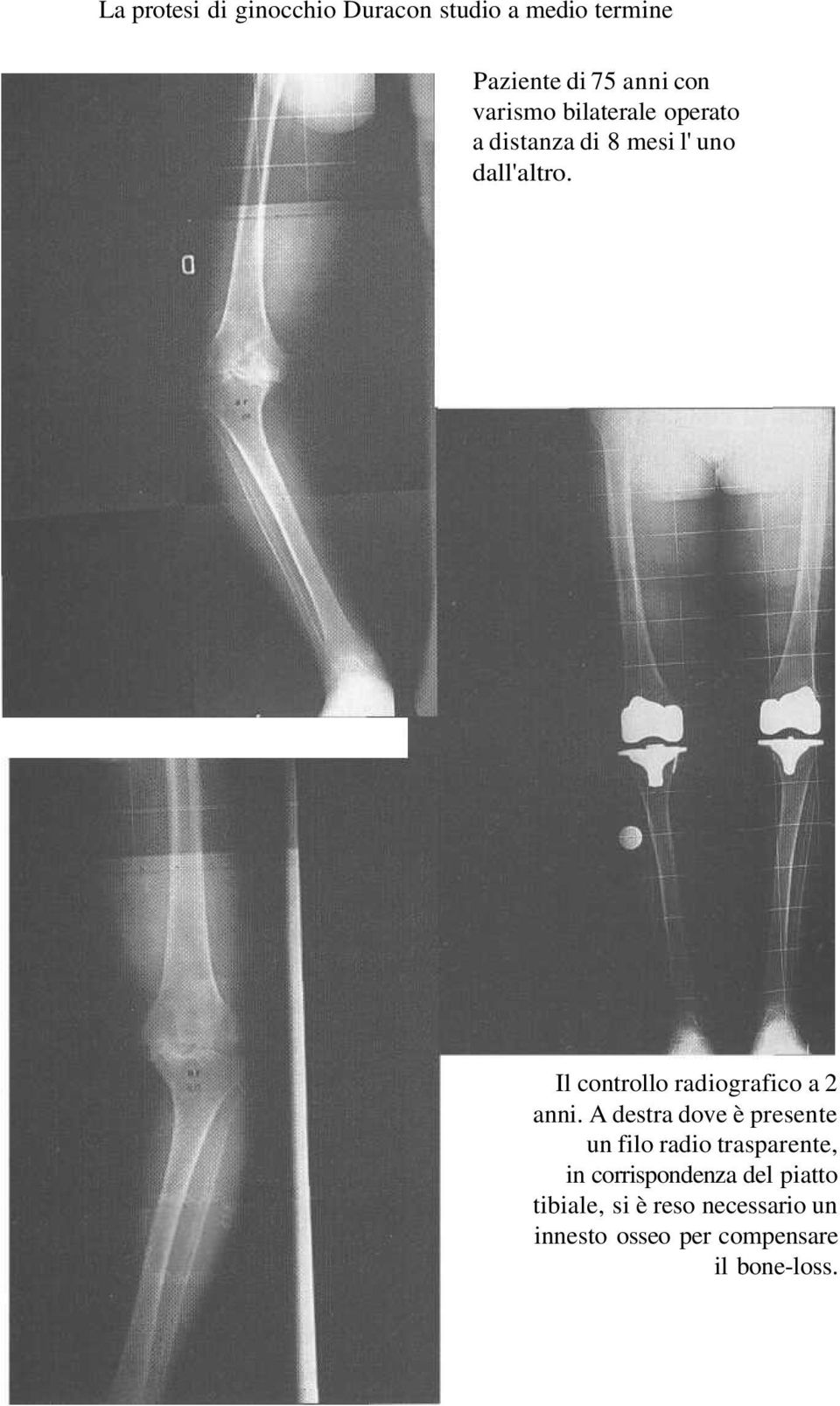 Il controllo radiografico a 2 anni.