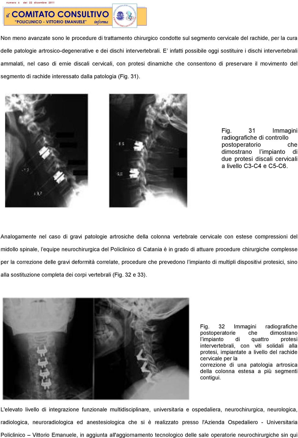 interessato dalla patologia (Fig. 31). Fig. 31 Immagini radiografiche di controllo postoperatorio che dimostrano l impianto di due protesi discali cervicali a livello C3-C4 e C5-C6.