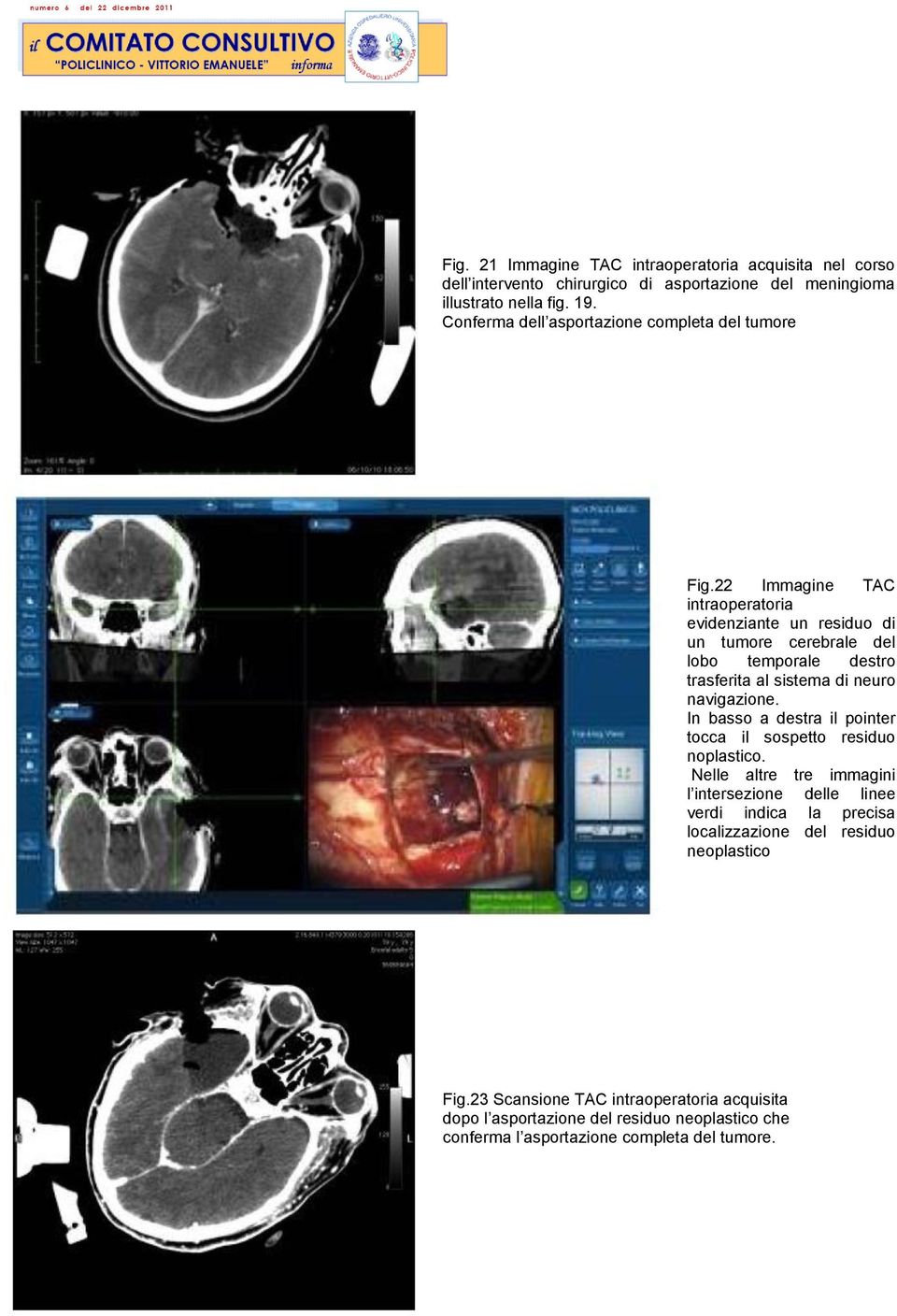 22 Immagine TAC intraoperatoria evidenziante un residuo di un tumore cerebrale del lobo temporale destro trasferita al sistema di neuro navigazione.