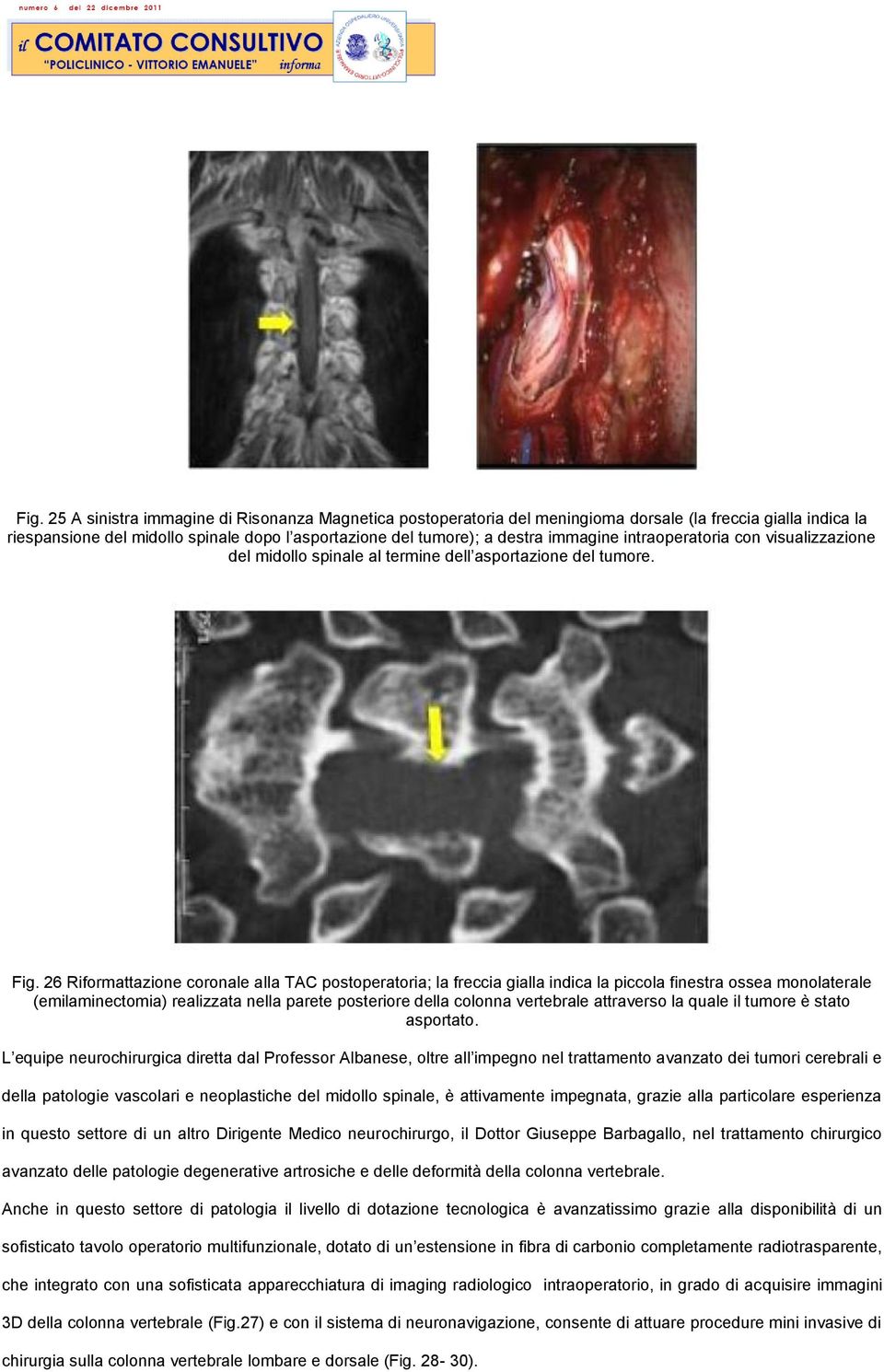 26 Riformattazione coronale alla TAC postoperatoria; la freccia gialla indica la piccola finestra ossea monolaterale (emilaminectomia) realizzata nella parete posteriore della colonna vertebrale