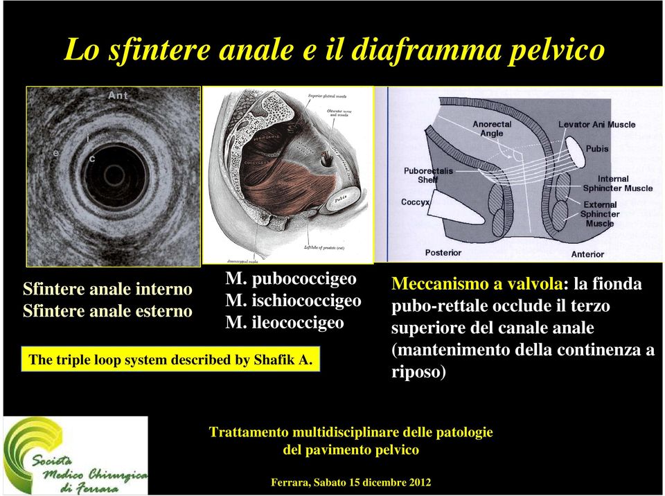 ileococcigeo The triple loop system described by Shafik A.